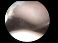 Lateral Patellar Release