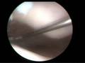 Lateral Patellar Release