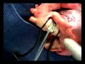 ascending-aorta-substitution-in-2-minutes.html