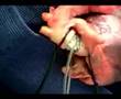Ascending Aorta substitution in 2 minutes