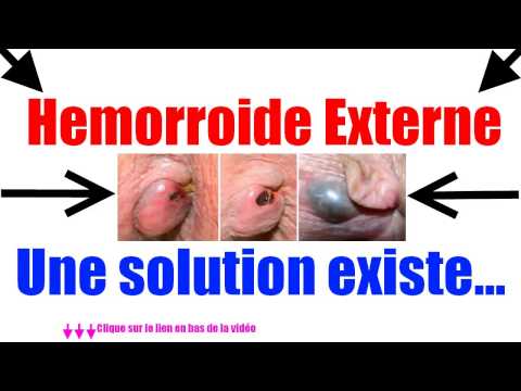 Hemorroide Externe - soigner hemorroides externes Hemorroide Externe - soigner hemorroides externes