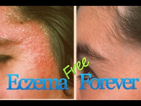 how to relieve eczema on face