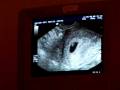 videos de Baby sonogram
