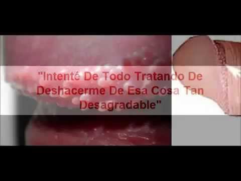 Como Curar Las Papulas Perladas - Tratamiento Sin Cirugia - papulasperladasjamas.blogspot.com