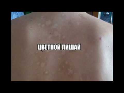 Через сколько проходит лишай на теле Через сколько проходит лишай на теле