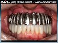 Protocolo superior é o nome dado a técnica que substitui todos dentes na arcada superior através de implantes dentários. O implante dental é um pequeno cilindro confeccionado em titânio puro, com roscas externas semelhante a um parafuso. O titânio adere ao tecido ósseo, produzindo uma ligação biológica entre o osso eo titânio, conhecida como osseointegração.