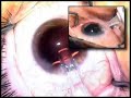 cataract surgery IOL insertion Uday Devgan MD lens implant cataract surgery IOL insertion Uday Devgan MD lens implant