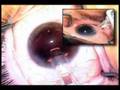 IOL Insertion - Cataract Surgery IOL Insertion - Cataract Surgery
