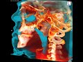 3D view of obstructed posterior nasal airway causing mouthbreathing and prognathism