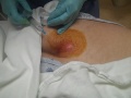 Pilonidal cyst being lanced. (loud gush noise when the Dr. cuts it)