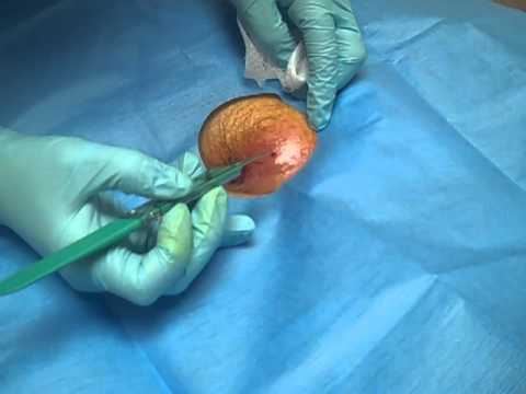 how to drain pilonidal cyst at home