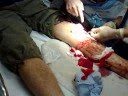 videos de MFL in A&E