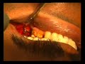 11 Testing Occlusion in dental implant (Dr Parijat Pallav)