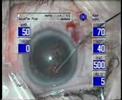 hydrodissection during cataract surgery . go under the capsula but not behind the iris margin. Push hard to siringe but do not muve the canula. Watch the flow going under the incicsion