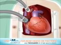 CABG