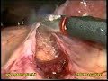 Video adenoma del surrene asportazione del surrene