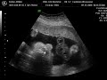 3D Ultrasound