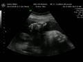 3D Ultrasound