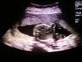 20w5d u/s