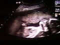 20w5d u/s 20w5d u/s