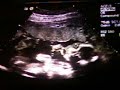 20w5d u/s
