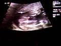 20w5d u/s