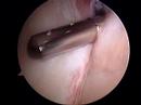 Cleaning up the labrum