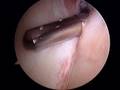 Cleaning up the labrum