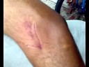 Dog bite