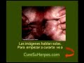 Herpes - Fotos - Como Curar lo y su Tratamiento