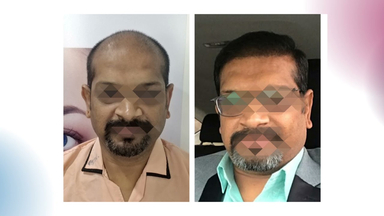 Hair transplant in vadodara with natural looking results.