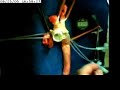 Experimental Aortic Arch Substitution with expandable prosth