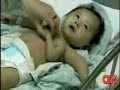 bebe com anomalia gen�tica