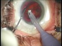 RLE and Alcon Restor IOL implantation, full nonedited video