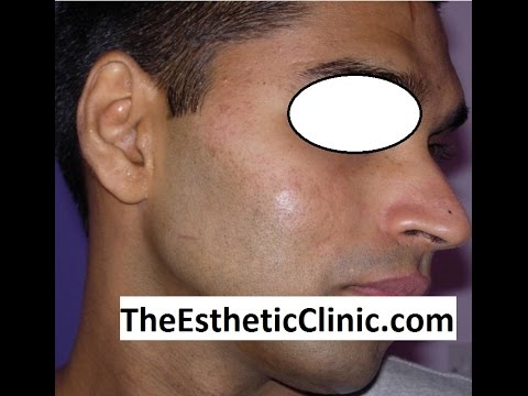 how to treat baby acne uk