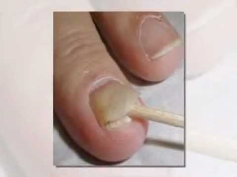 how to kill fungus under fingernail