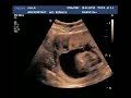 BABY ULTRASOUND ITS A GIRL! 22 WEEKS