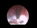 Endoscopy of the Brain - Brain Biopsy