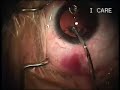 RLE, Katarak, Cataract Surgery RLE, Katarak, Cataract Surgery