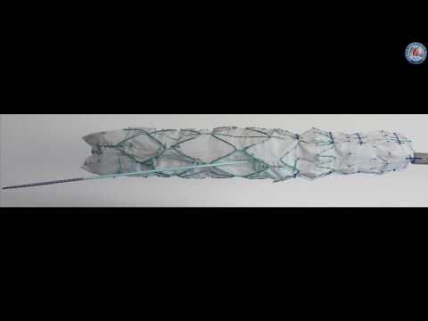 Endovascular arch replacement with an endoprosthesis with three inner branches