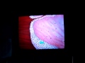 Cervical Dysplasia