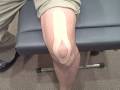 Knee  ACL