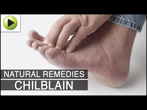 how to cure chilblains