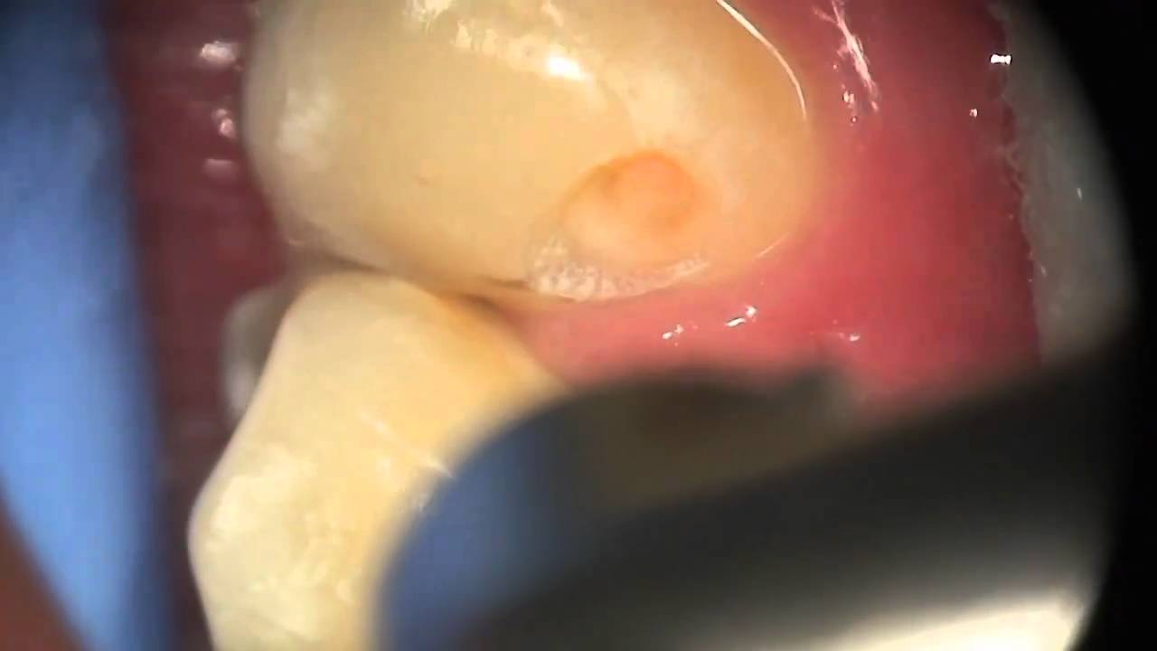 Minimally Invasive Laser Dentistry - Part 01
