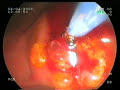 Pankreas Ba?? Tümörü Metal Stent Yerle?tirme Pankreas Ba?? Tümörü Metal Stent Yerle?tirme