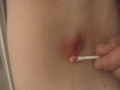 Oozing bloody pus