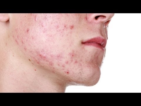 how to shave with acne