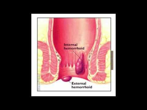 how to cure hemorrhoids nhs