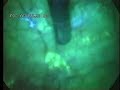 Hyperfluorescent Endometriosis Hyperfluorescent Endometriosis