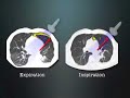 Pulmonary Ultrasound in Dyspnea Pulmonary Ultrasound in Dyspnea